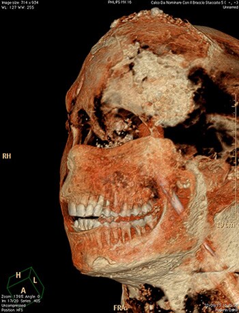 How Philips scanners brought Pompeii to life