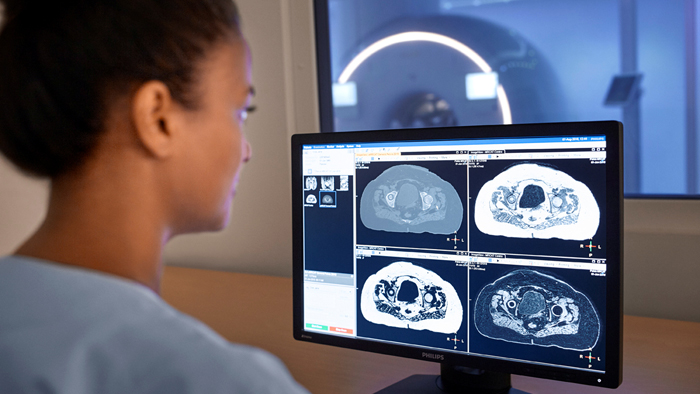 Including MRI in radiation therapy planning | FieldStrength | Philips