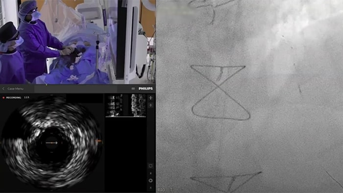 First in human Complex PCI case with OmniWire – the world’s first solid core pressure wire Dr. J. Singh