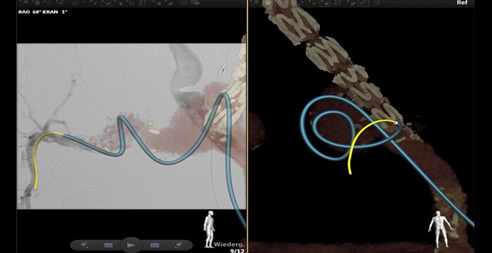 Catheterization of the right internal iliac artery crossing an aneurism