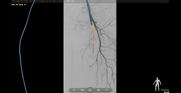 Navigation through stenotic vessels