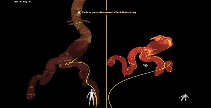 Navigation through tortuous iliac artery