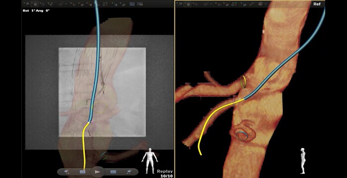 Catheterization SMA through fenestrated EVAR with brachial access