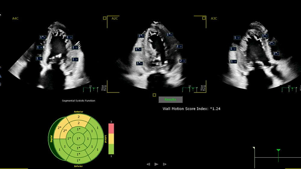 EPIQ CVx and Affiniti CVx with Segmental Wall Motion