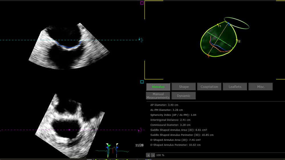 EPIQ CVx and CVxi with 3D Auto MV