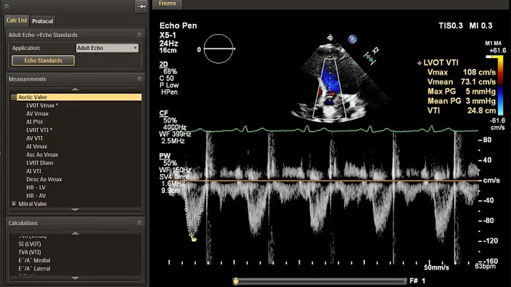 EPIQ CVx and CVxi with Smart Doppler View ID