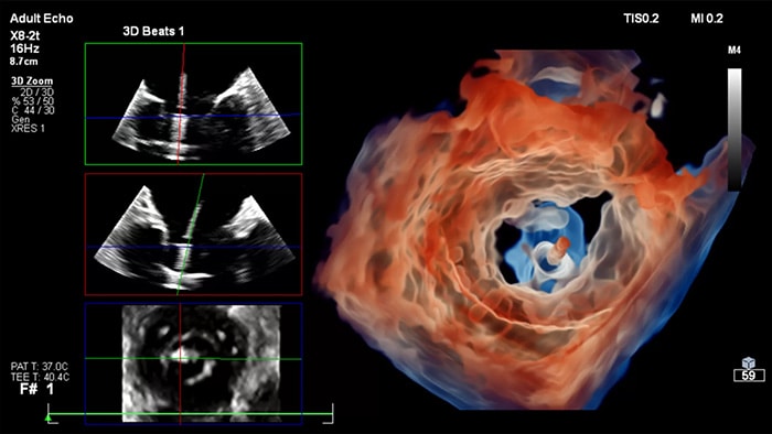 Philips accelerates ultrasound innovation with GPU-powered beamforming and AI