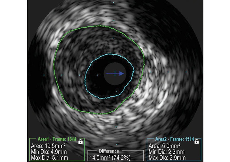 IVUS image