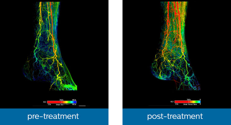 smart perfusion