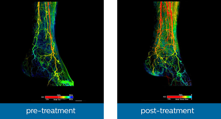 smart perfusion