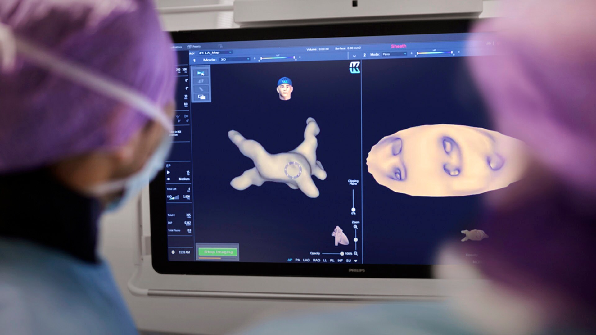 How a new way of visualizing the heart can help fight atrial fibrillation