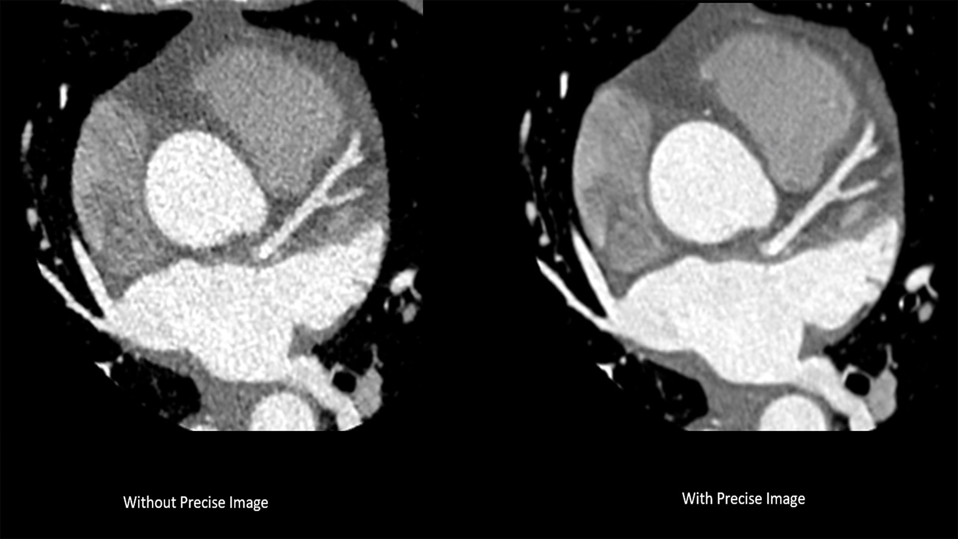 A complex cardiac scan taken with a CT 5300 scanner.