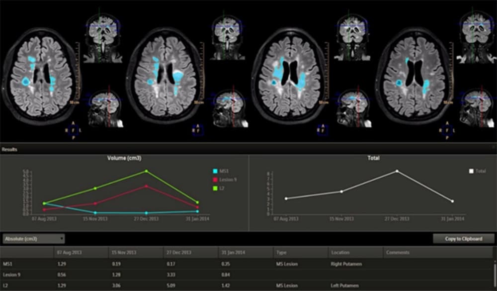 Brain MR