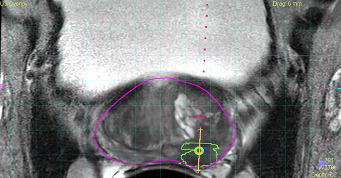 Targeted biopsy