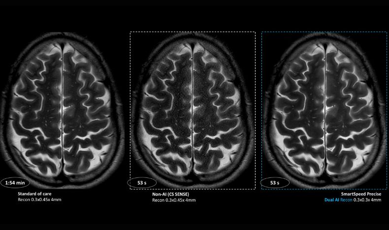 SmartSpeed Precise brain speed comparison