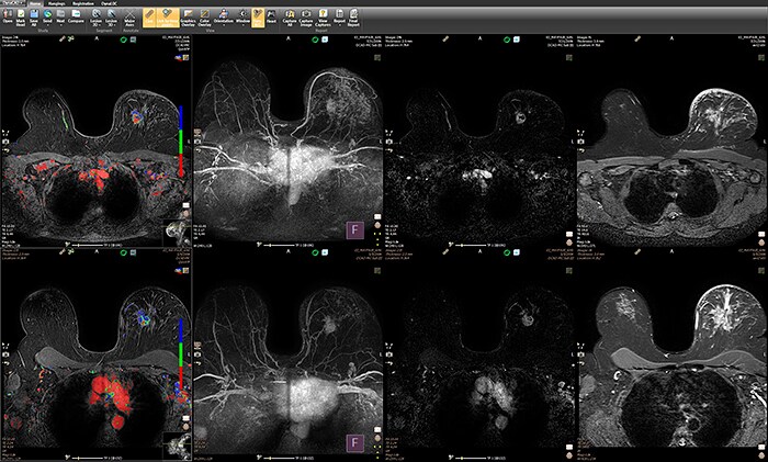 Download image (.jpg) IntelliSpace Portal 10 supports Philips expansion into DynaCAD Breast solutions (opens in a new window)