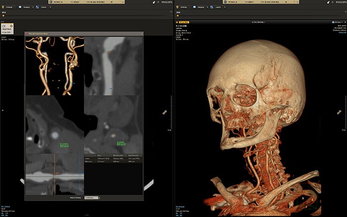 Download image (.jpg) Philips Illumeo combines contextual awareness capabilities with advanced data analytics to augment the work of the radiologist (opens in a new window)