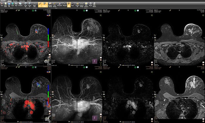 Download image (.jpg) Philips IntelliSpace Portal advanced visualization and quantification platform (opens in a new window)