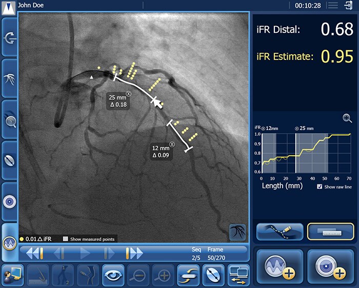 Download image (.jpg) Philips SyncVision iFR Co registration (opens in a new window)