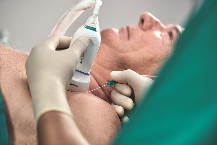 Download image (.jpg) Onvision guidance solution for regional anesthesia from Philips and B. Braun (opens in a new window)