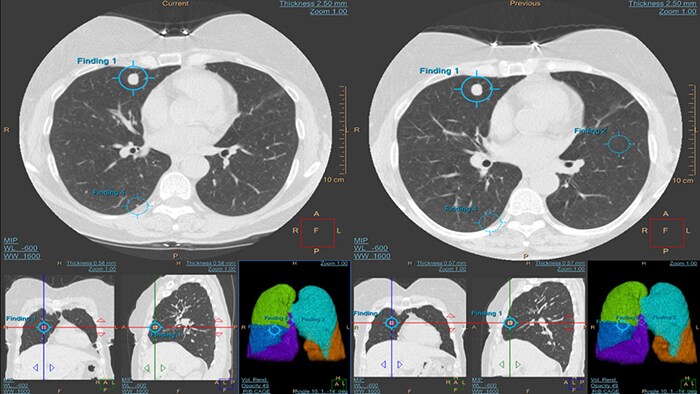 CT Lung Cancer Screening