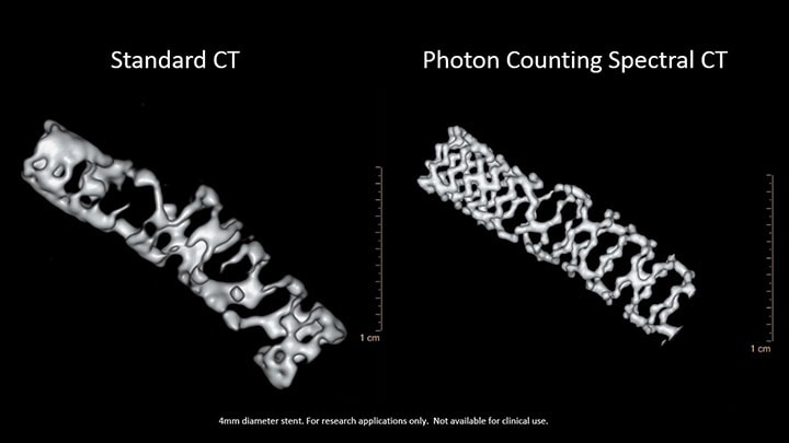 Comparison showing 4mm stent