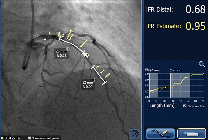 Download image (.jpg) Philips SyncVision with iFR Co registration (opens in a new window)