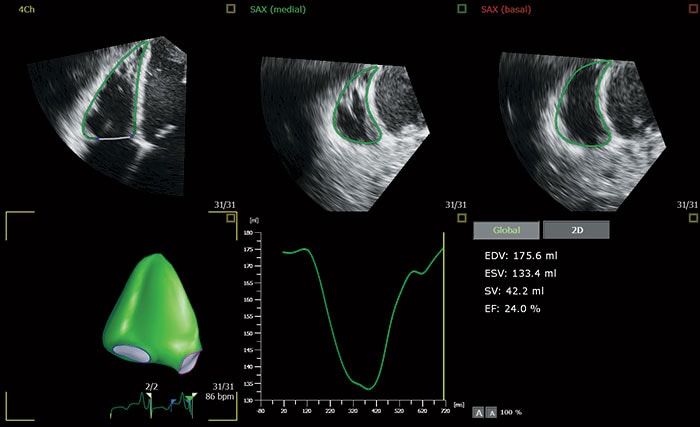 The Role of Strain Imaging in Oncology and Vendor-to-Vendor Variability -  American College of Cardiology