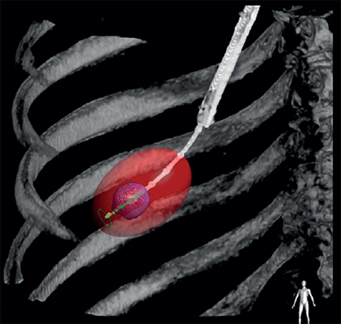 ablation capture thumb