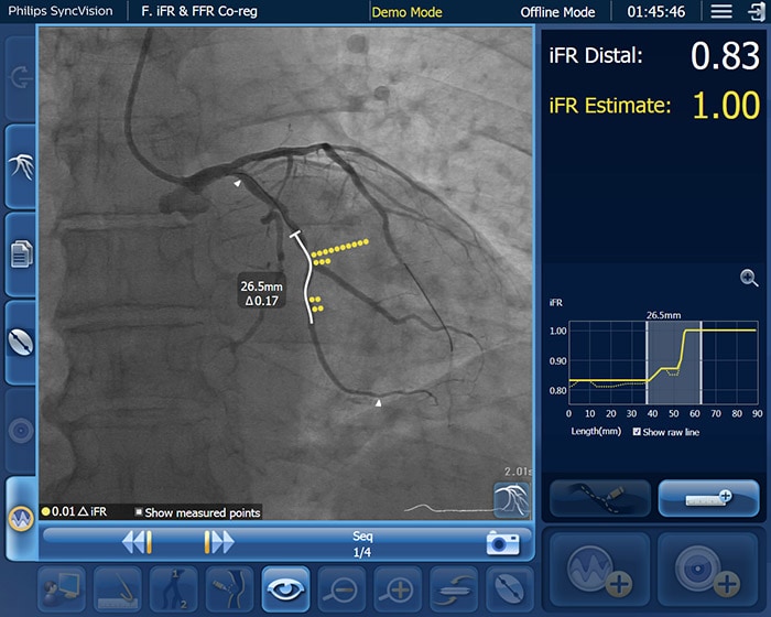 Download image (.jpg) iFR data co-registered on the angiogram