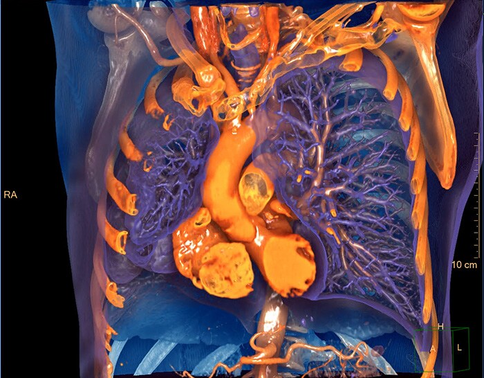 Download image (.jpg) : IntelliSpace Portal 12 Photorealistic Chest 3D Image