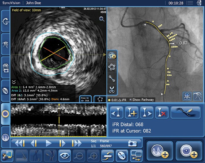 Download image (.jpg) iFR data co registered on the angiogram (opens in a new window)