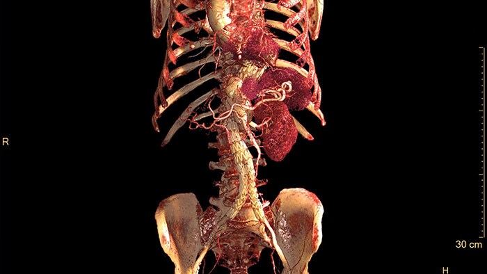 ISP 12 3D vascular