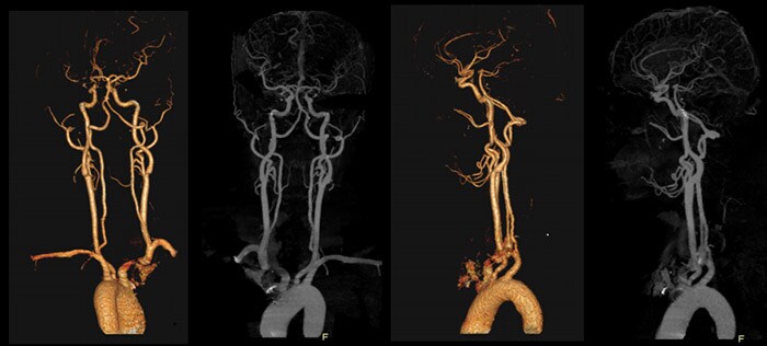 Download image (.jpg) Precise Suite Incisive carotid (opens in a new window)