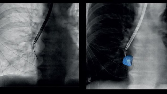 3d Image Guided Lung Cancer Biopsy News Philips