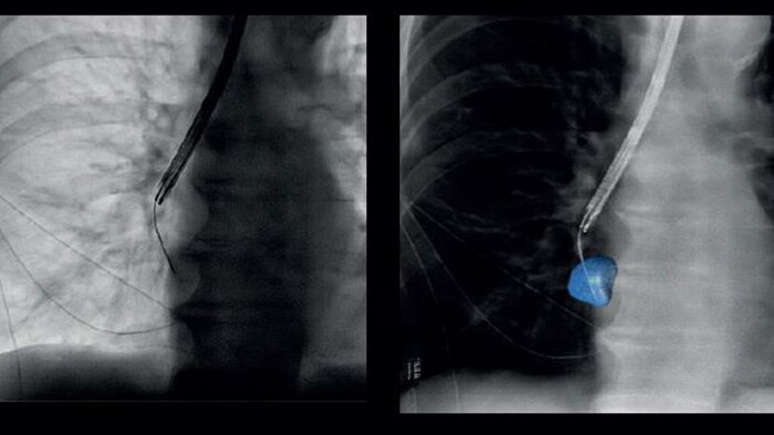 Radboud university medical center pioneers lung cancer diagnosis with Philips technology for bronchoscopic procedures