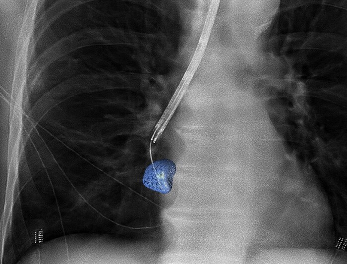 Download image (.jpg) Lung biopsy using Philips 3D navigation