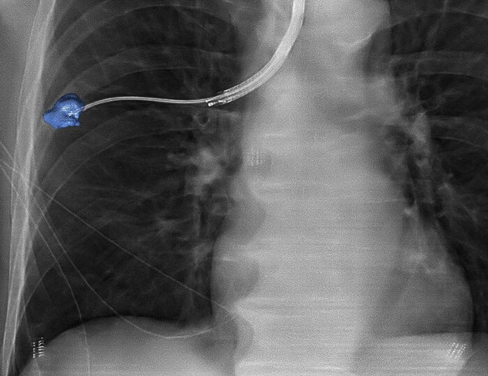 Download image (.jpg) Lung biopsy using Philips 3D navigation
