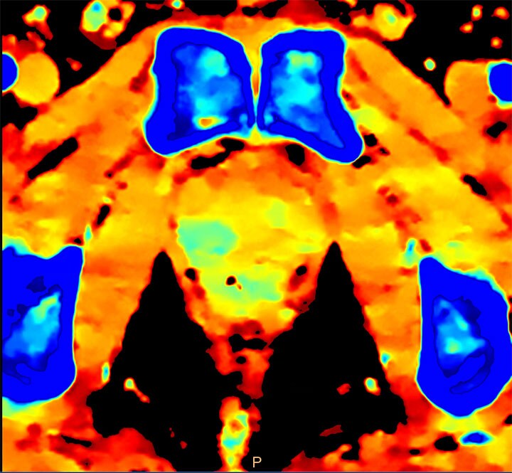 Clinical image for prostate lesion