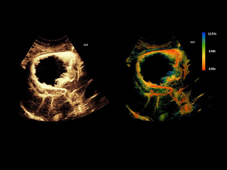 Epiq liver ceus clinical