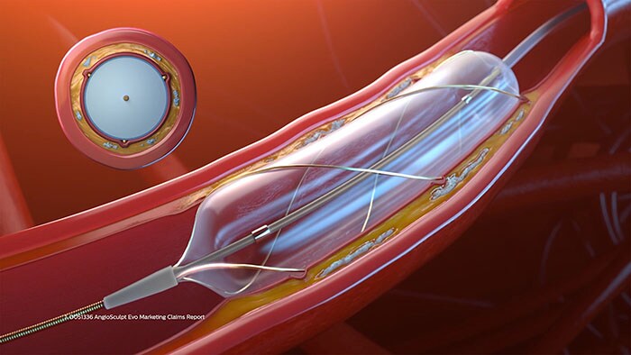 Philips showcases its latest portfolio of cardiology innovations that deliver clinical confidence and efficiency in treating cardiac disease at EuroPCR 2023