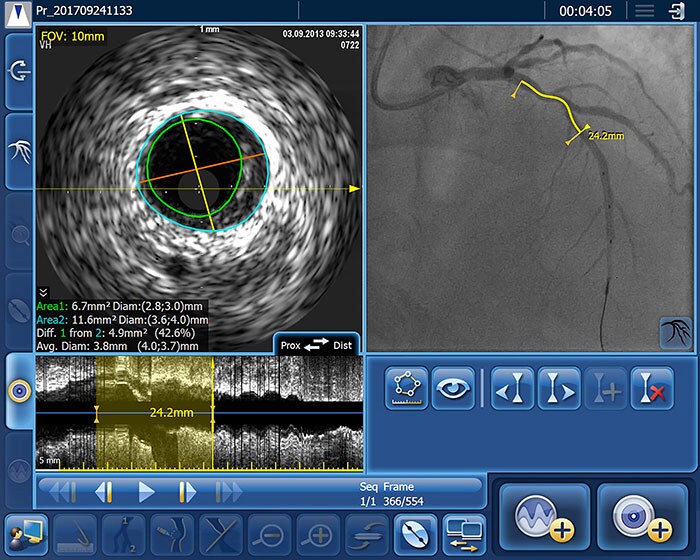 s2-4-ivus-co-reg-with-length-area