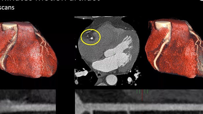 Spectral CT 7500 -  