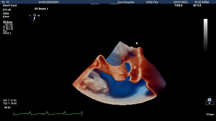 3D view of adult left atrial appendage -  