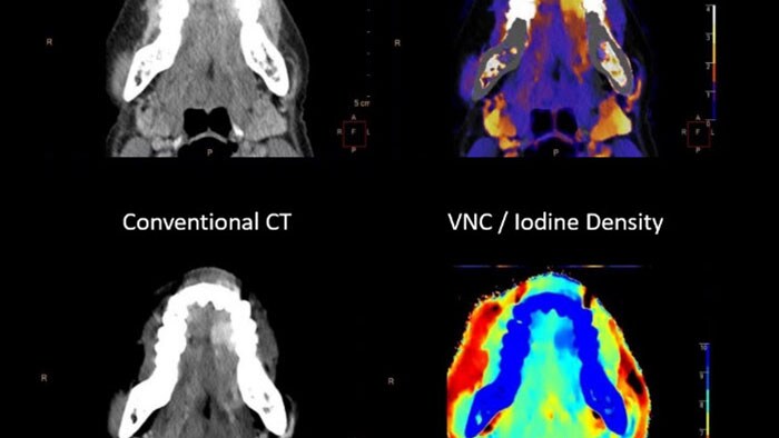 Spectral CT 7500 RT clinical -  