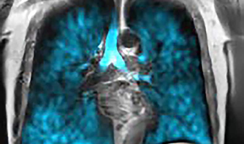 MR lung images with Xenon gas