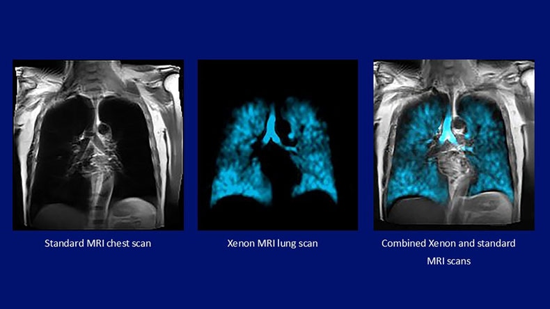 MR chest images with Xenon Gas and without