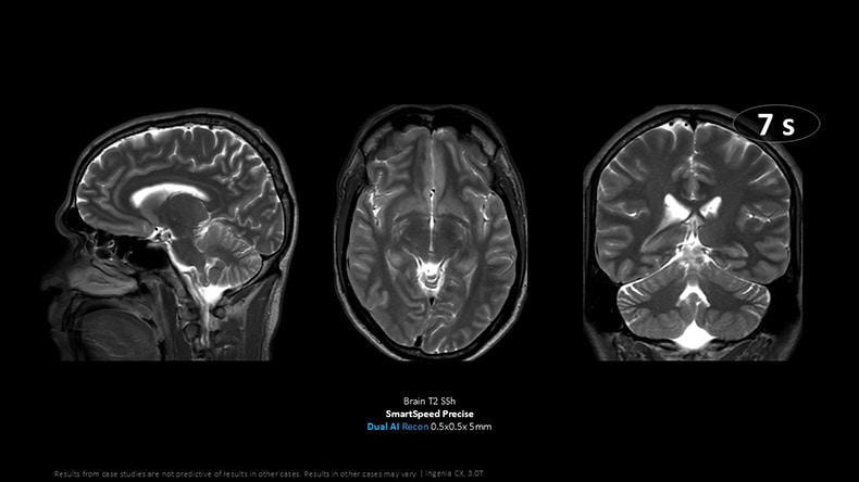 7 second brain exam with SmartSpeed Precise dual AI