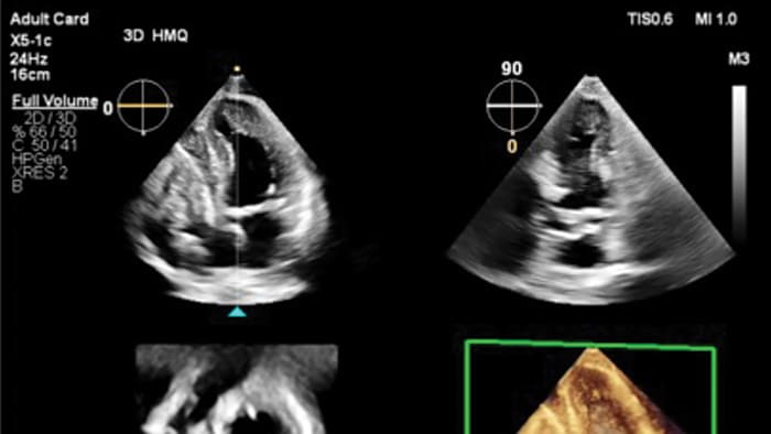 EPIQ CVx system clinical view -  