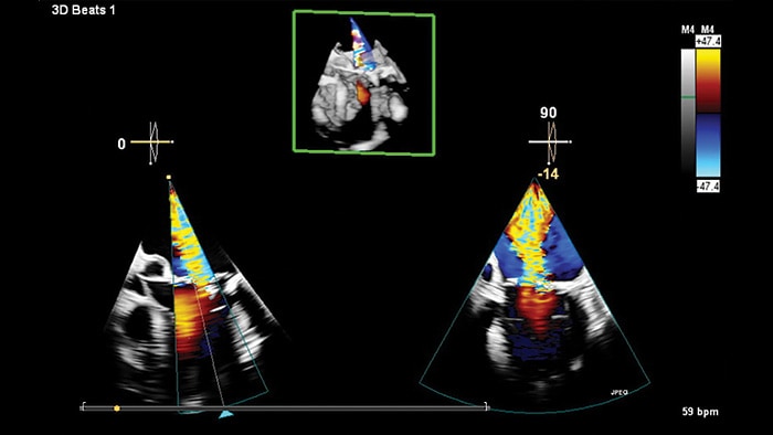 Mini 3D TEE transducer clinical view -  